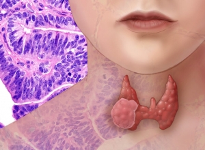 Ung thư tuyến giáp: Có mấy loại? Gây những nguy hiểm gì cho người bệnh?